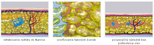 Liposukcia - bunky