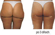 Liposukcia - operácia