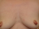 Zväčšenie prsníkov - predtým